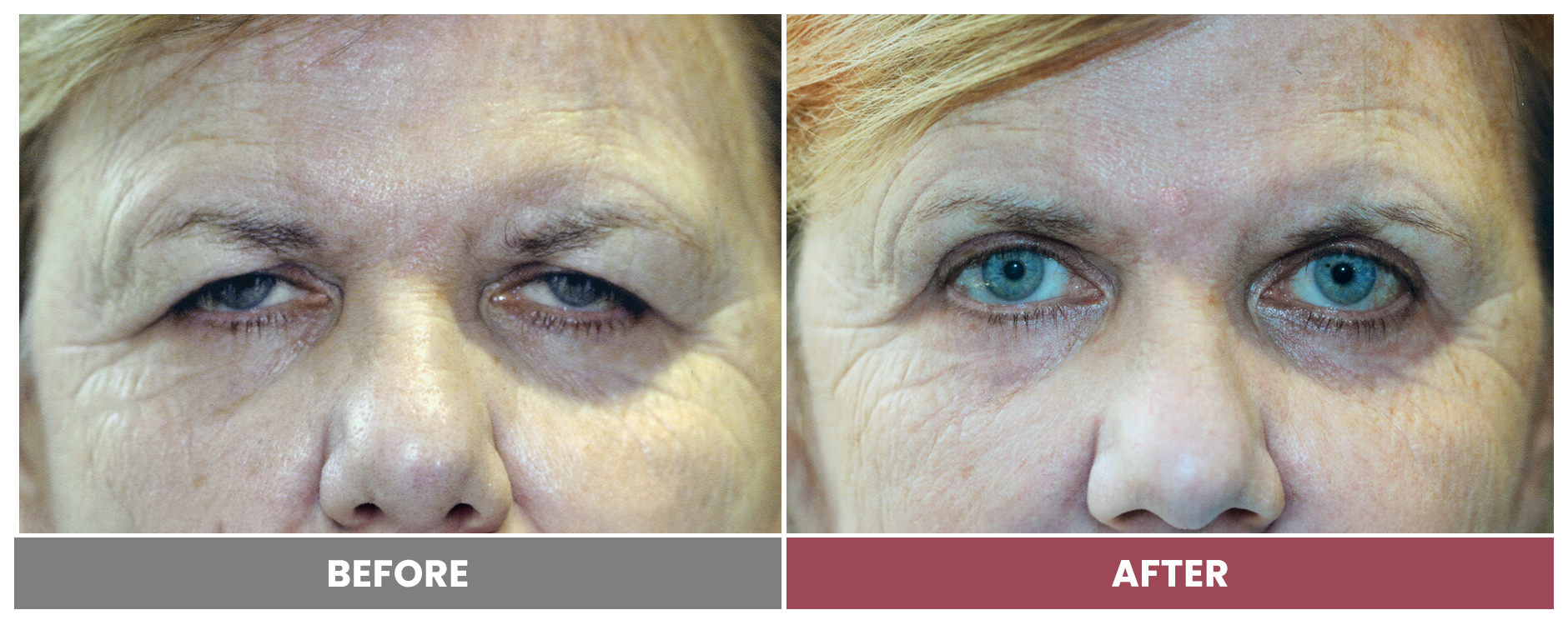 Upper Blepharoplasty - Case 81